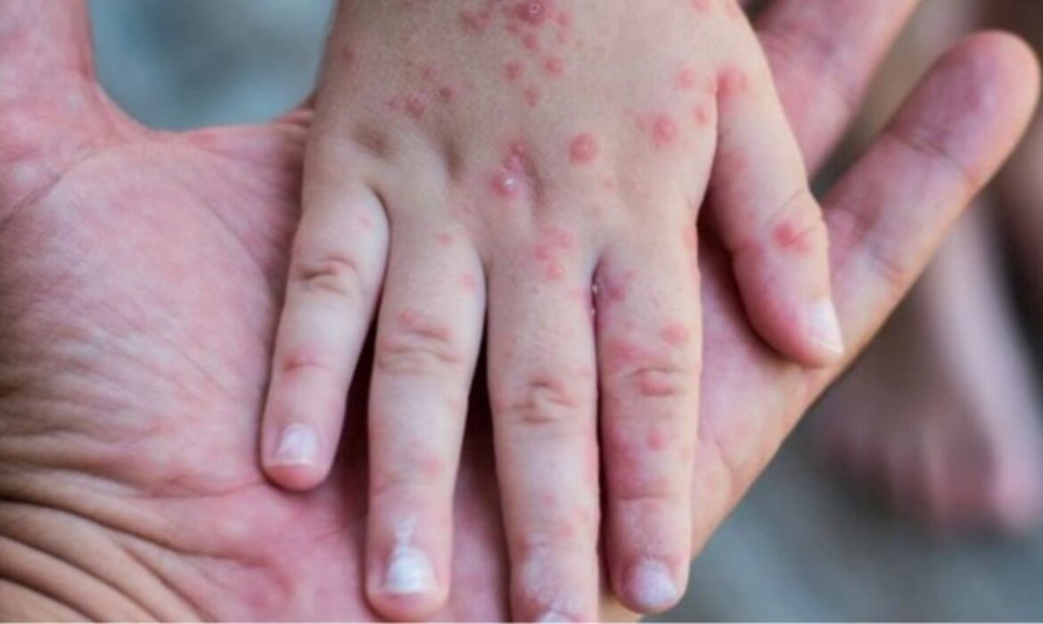 TPHCM công bố dịch sởi